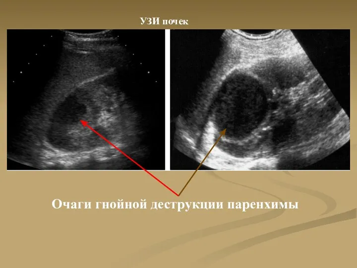 Очаги гнойной деструкции паренхимы УЗИ почек