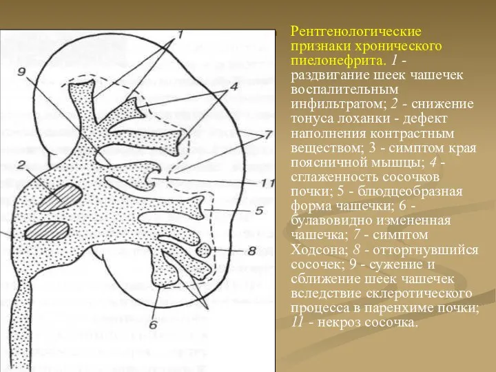 Рентгенологические признаки хронического пиелонефрита. 1 - раздвигание шеек чашечек воспалительным