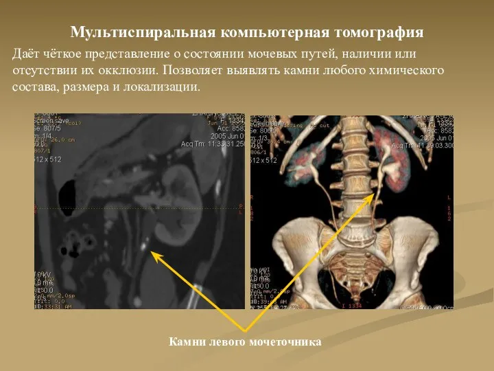 Мультиспиральная компьютерная томография Даёт чёткое представление о состоянии мочевых путей,