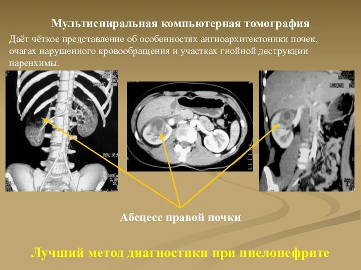 Лучший метод диагностики при пиелонефрите Мультиспиральная компьютерная томография Даёт чёткое