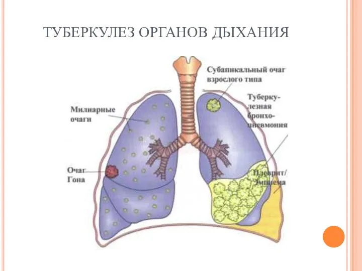 ТУБЕРКУЛЕЗ ОРГАНОВ ДЫХАНИЯ