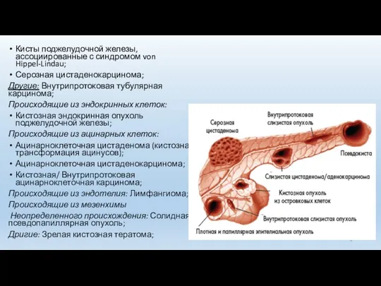 Кисты поджелудочной железы, ассоциированные с синдромом von Hippel-Lindau; Серозная цистаденокарцинома;