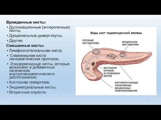 Врожденные кисты: Дупликационные (энтерогенные) кисты; Дуоденальные дивертикулы; Другие; Смешанные кисты: