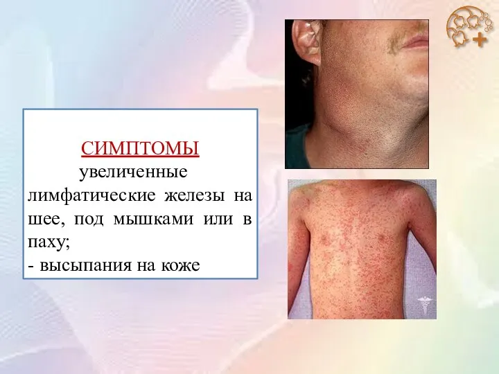 СИМПТОМЫ увеличенные лимфатические железы на шее, под мышками или в паху; - высыпания на коже