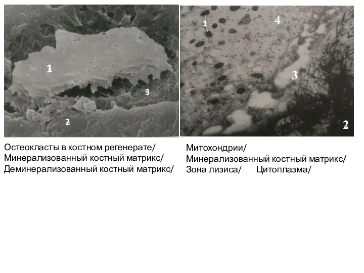 Остеокласты в костном регенерате/ Минерализованный костный матрикс/ Деминерализованный костный матрикс/