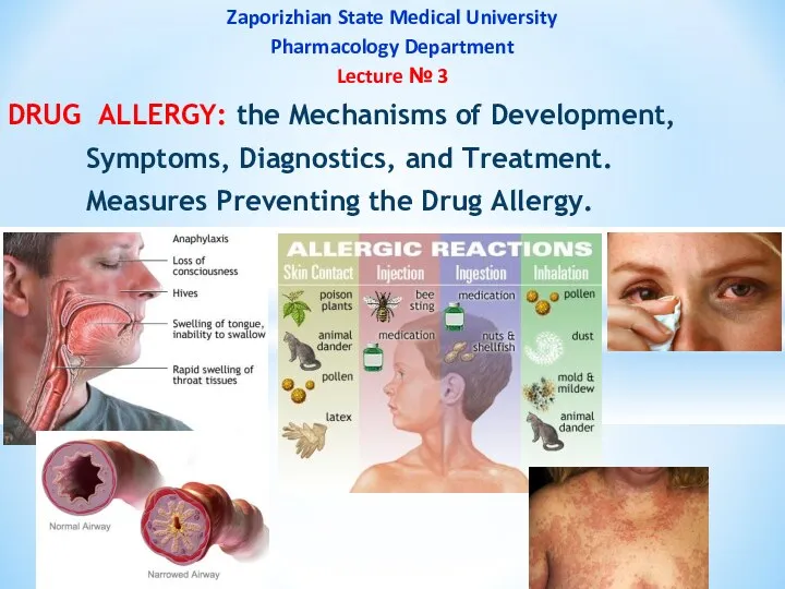 Drug allergy: the mechanisms of development, symptoms, diagnostics, and treatment. Measures preventing the drug allergy