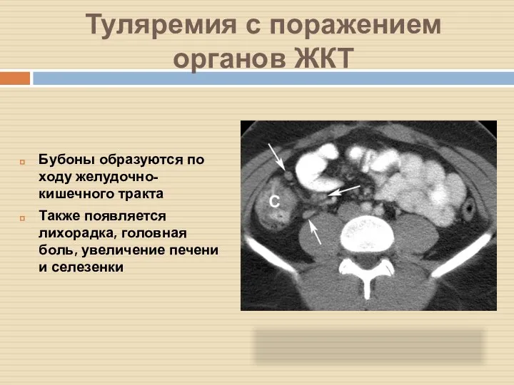 Туляремия с поражением органов ЖКТ Бубоны образуются по ходу желудочно-кишечного