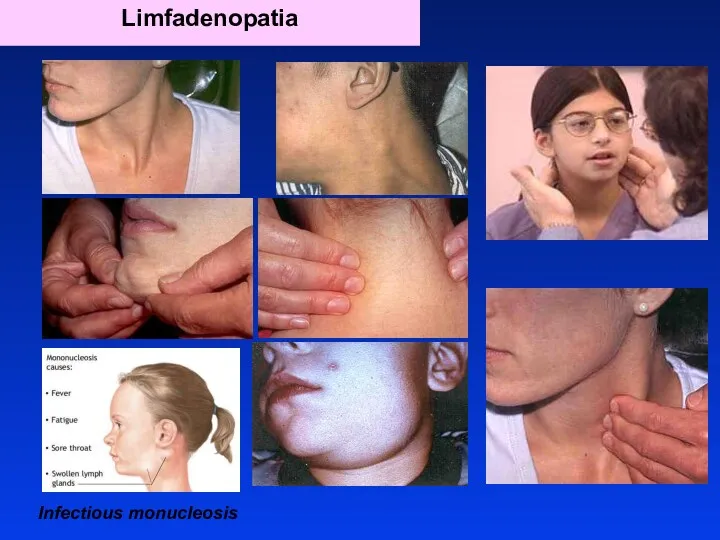 Limfadenopatia Infectious monucleosis