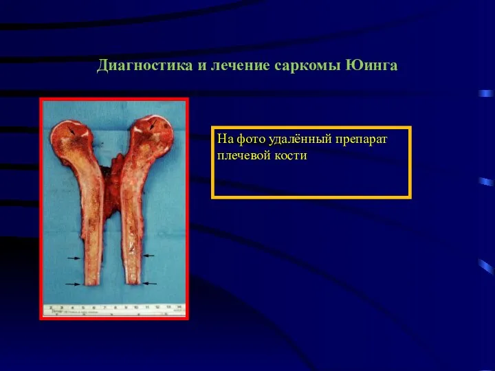 Диагностика и лечение саркомы Юинга На фото удалённый препарат плечевой кости