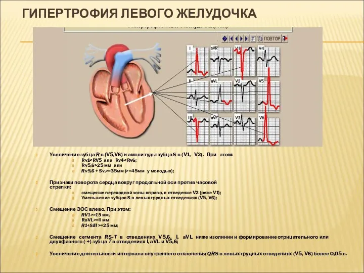 ГИПЕРТРОФИЯ ЛЕВОГО ЖЕЛУДОЧКА Увеличение зубца R в (V5,V6) и амплитуды