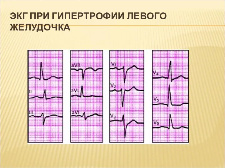 ЭКГ ПРИ ГИПЕРТРОФИИ ЛЕВОГО ЖЕЛУДОЧКА