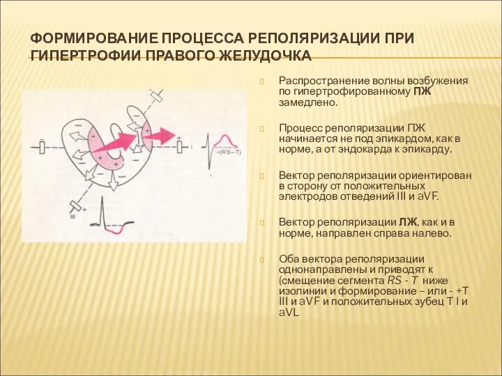 ФОРМИРОВАНИЕ ПРОЦЕССА РЕПОЛЯРИЗАЦИИ ПРИ ГИПЕРТРОФИИ ПРАВОГО ЖЕЛУДОЧКА Распространение волны возбужения