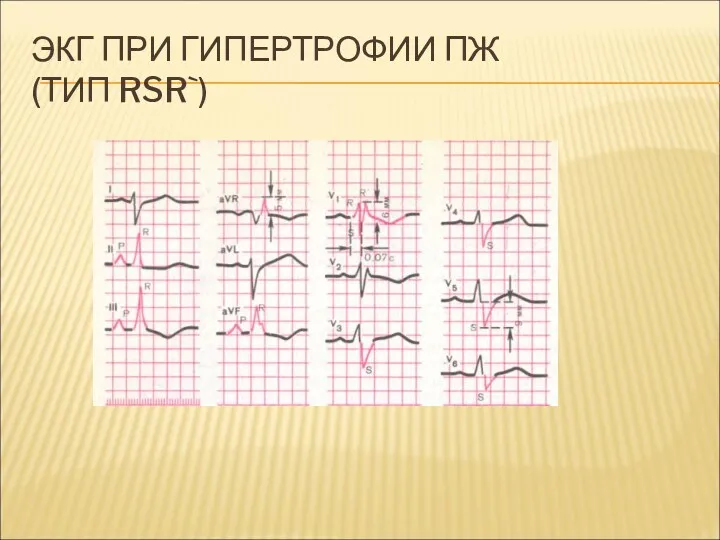 ЭКГ ПРИ ГИПЕРТРОФИИ ПЖ (ТИП RSR`)