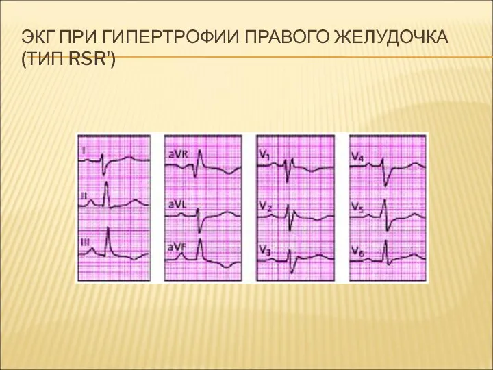 ЭКГ ПРИ ГИПЕРТРОФИИ ПРАВОГО ЖЕЛУДОЧКА (ТИП RSR')