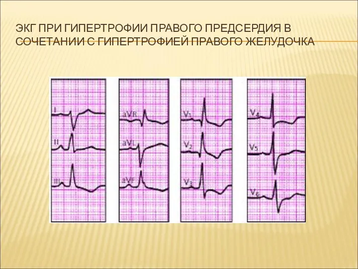 ЭКГ ПРИ ГИПЕРТРОФИИ ПРАВОГО ПРЕДСЕРДИЯ В СОЧЕТАНИИ С ГИПЕРТРОФИЕЙ ПРАВОГО ЖЕЛУДОЧКА