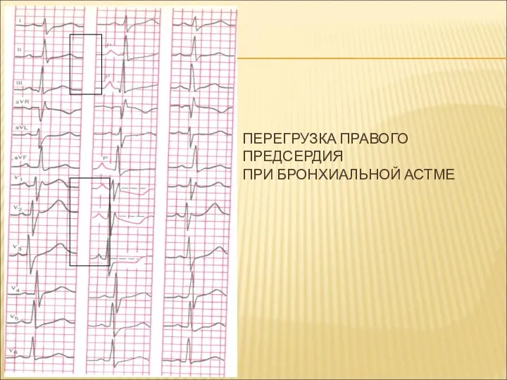 ПЕРЕГРУЗКА ПРАВОГО ПРЕДСЕРДИЯ ПРИ БРОНХИАЛЬНОЙ АСТМЕ