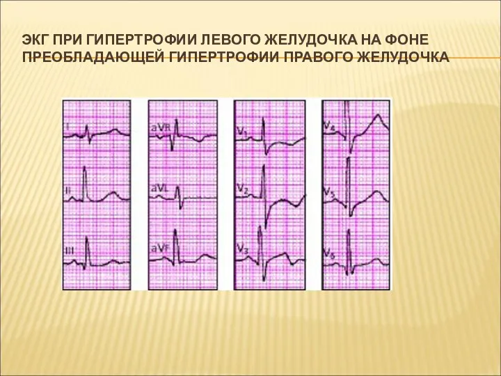 ЭКГ ПРИ ГИПЕРТРОФИИ ЛЕВОГО ЖЕЛУДОЧКА НА ФОНЕ ПРЕОБЛАДАЮЩЕЙ ГИПЕРТРОФИИ ПРАВОГО ЖЕЛУДОЧКА