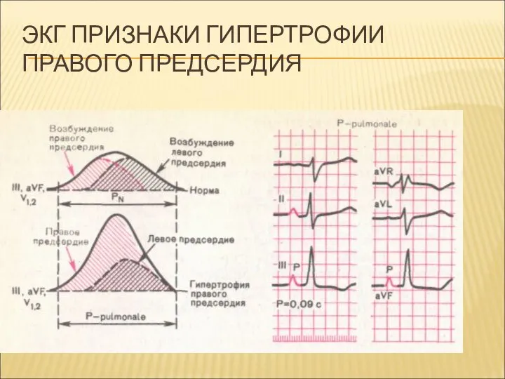 ЭКГ ПРИЗНАКИ ГИПЕРТРОФИИ ПРАВОГО ПРЕДСЕРДИЯ