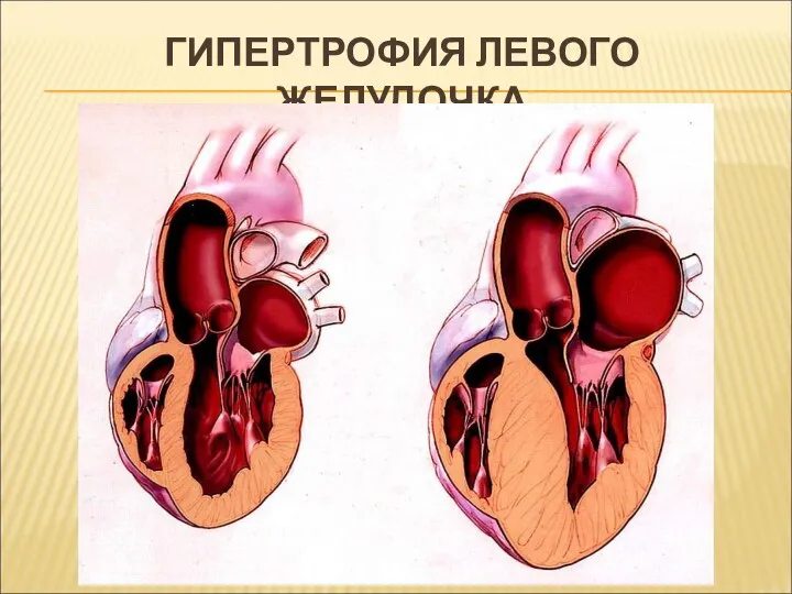 ГИПЕРТРОФИЯ ЛЕВОГО ЖЕЛУДОЧКА