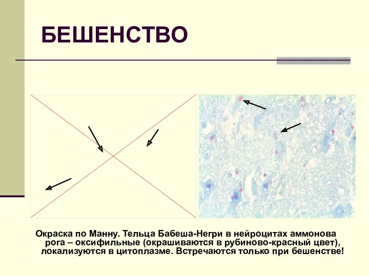 БЕШЕНСТВО Окраска по Манну. Тельца Бабеша-Негри в нейроцитах аммонова рога – оксифильные (окрашиваются