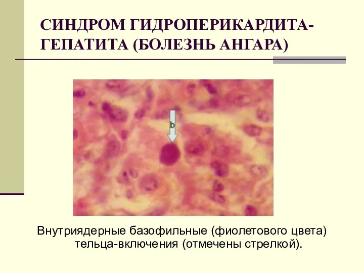 СИНДРОМ ГИДРОПЕРИКАРДИТА-ГЕПАТИТА (БОЛЕЗНЬ АНГАРА) Внутриядерные базофильные (фиолетового цвета) тельца-включения (отмечены стрелкой).