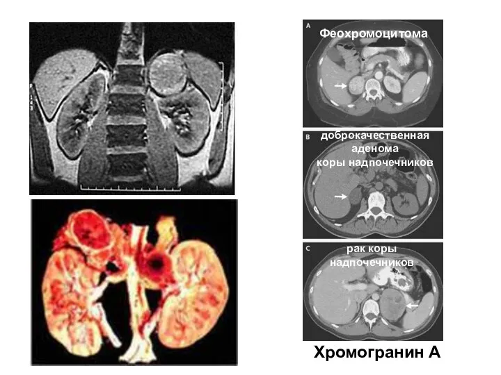 Феохромоцитома доброкачественная аденома коры надпочечников рак коры надпочечников Хромогранин А