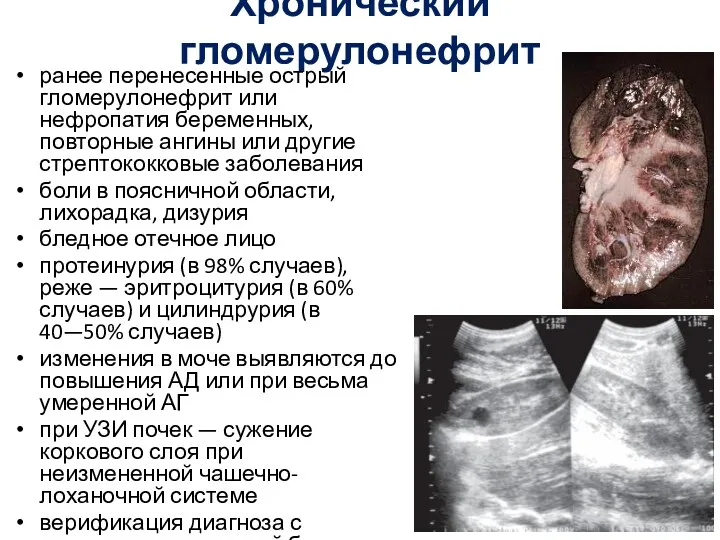 Хронический гломерулонефрит ранее перенесенные острый гломерулонефрит или нефропатия беременных, повторные