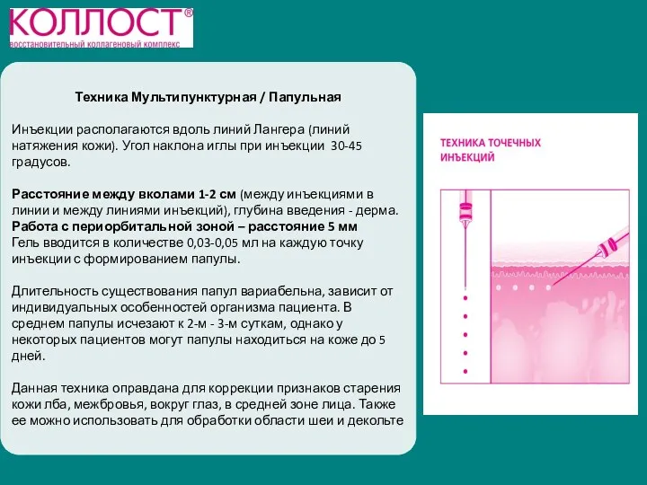 Техника Мультипунктурная / Папульная Инъекции располагаются вдоль линий Лангера (линий