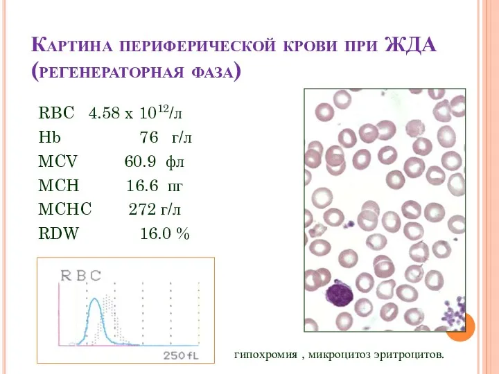 Картина периферической крови при ЖДА (регенераторная фаза) RBC 4.58 x