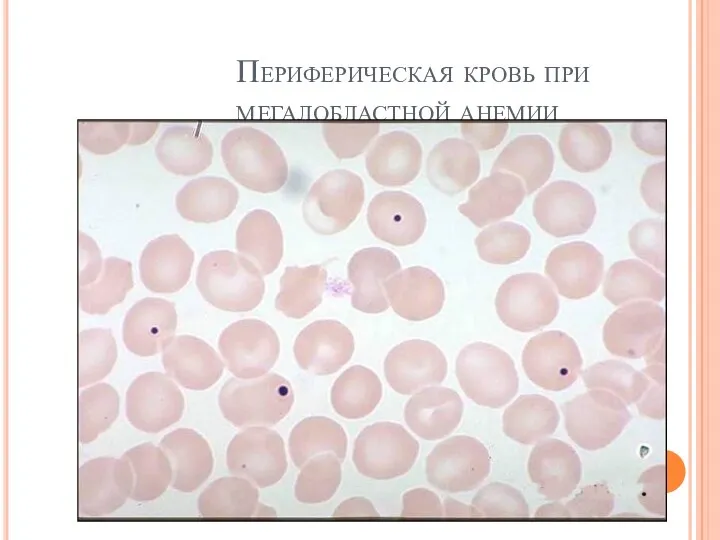 Периферическая кровь при мегалобластной анемии