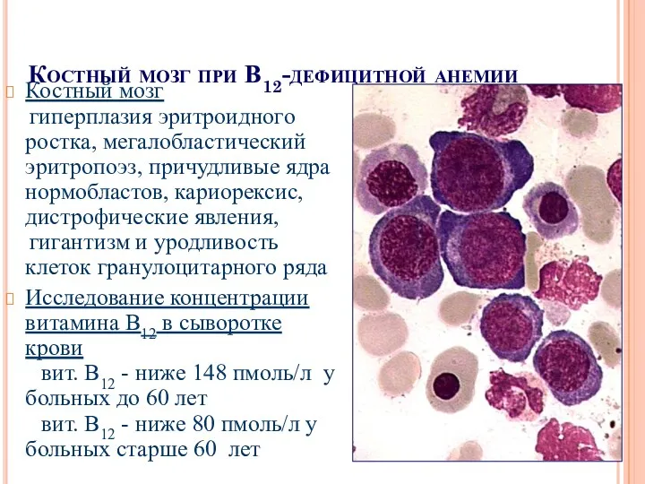 Костный мозг при В12-дефицитной анемии Костный мозг гиперплазия эритроидного ростка,