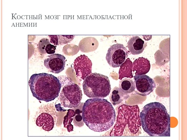 Костный мозг при мегалобластной анемии