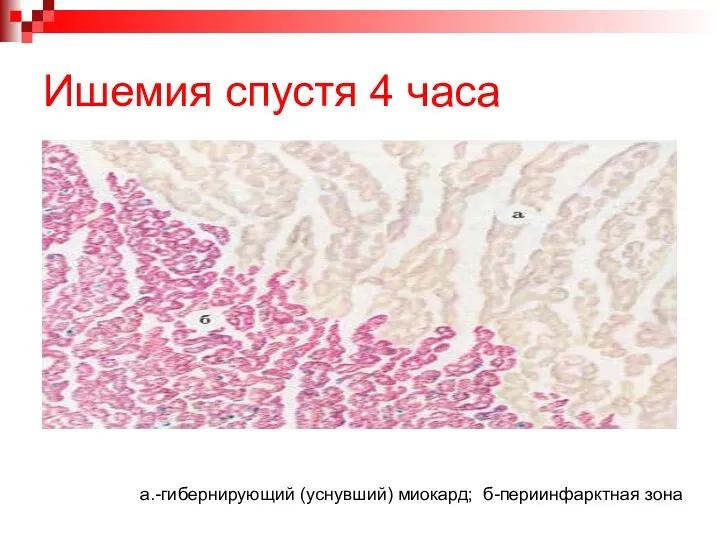 Ишемия спустя 4 часа а.-гибернирующий (уснувший) миокард; б-периинфарктная зона