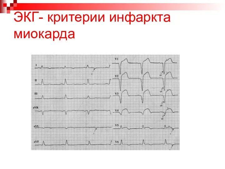 ЭКГ- критерии инфаркта миокарда