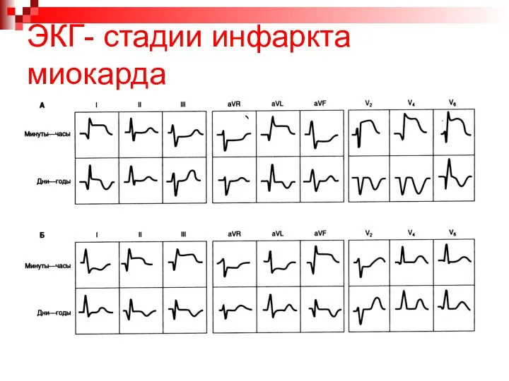 ЭКГ- стадии инфаркта миокарда