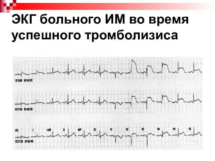 ЭКГ больного ИМ во время успешного тромболизиса