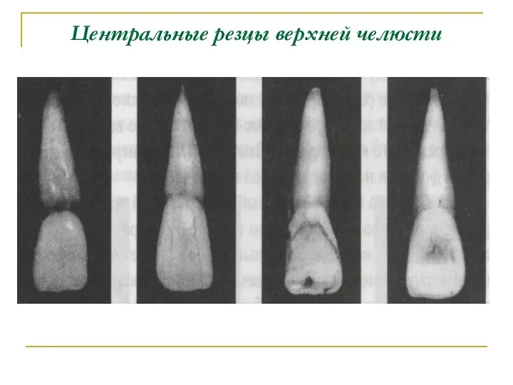 Центральные резцы верхней челюсти