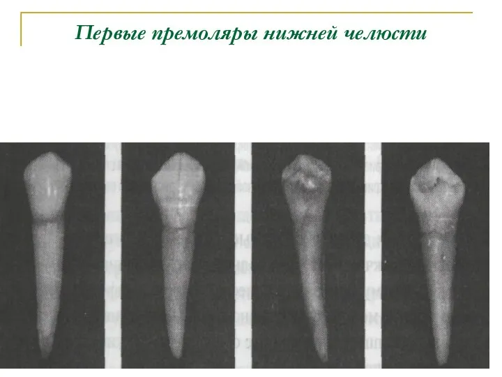 Первые премоляры нижней челюсти