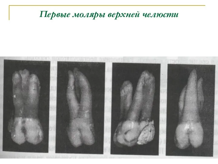 Первые моляры верхней челюсти