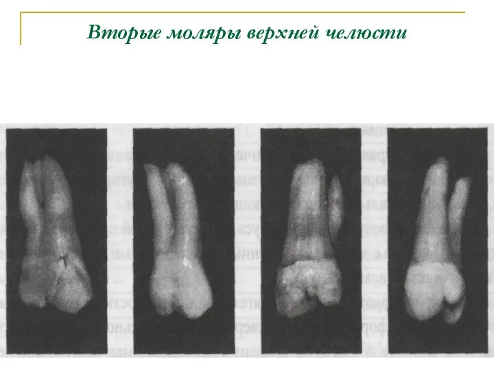 Вторые моляры верхней челюсти