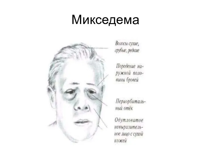 Микседема