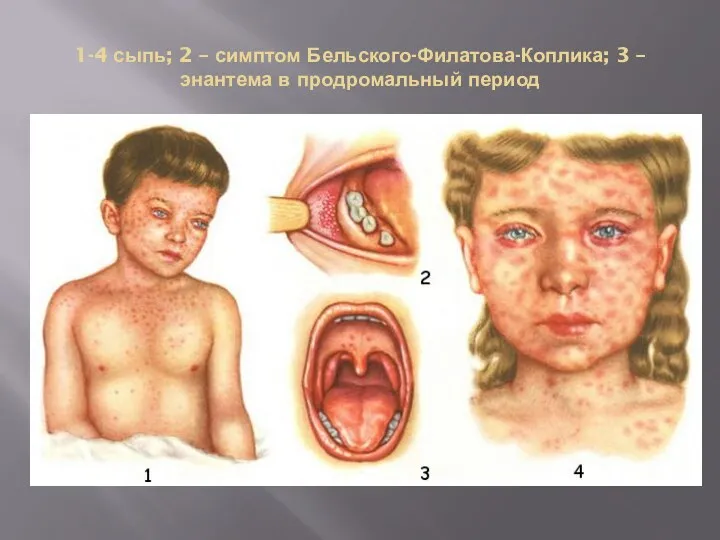 1-4 сыпь; 2 – симптом Бельского-Филатова-Коплика; 3 – энантема в продромальный период