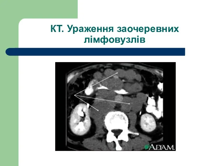 КТ. Ураження заочеревних лімфовузлів