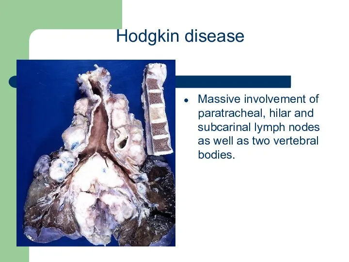 Hodgkin disease Massive involvement of paratracheal, hilar and subcarinal lymph