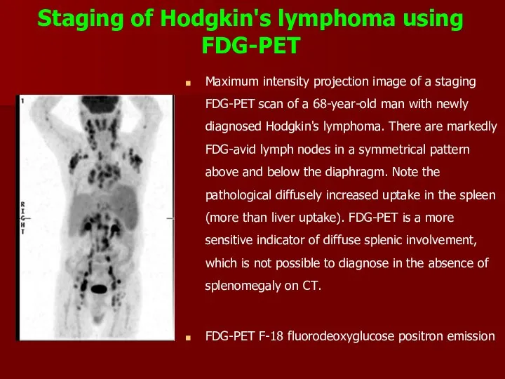 Staging of Hodgkin's lymphoma using FDG-PET Maximum intensity projection image