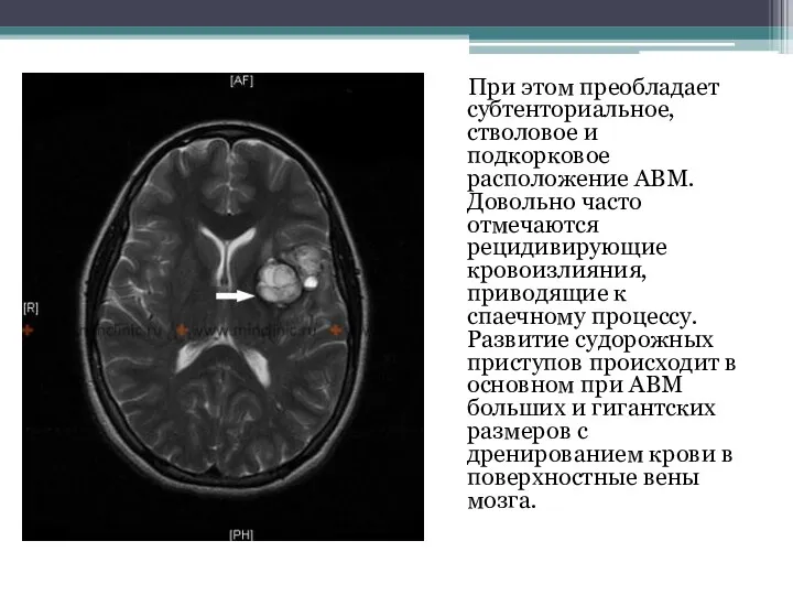 При этом преобладает субтенториальное, стволовое и подкорковое расположение АВМ. Довольно