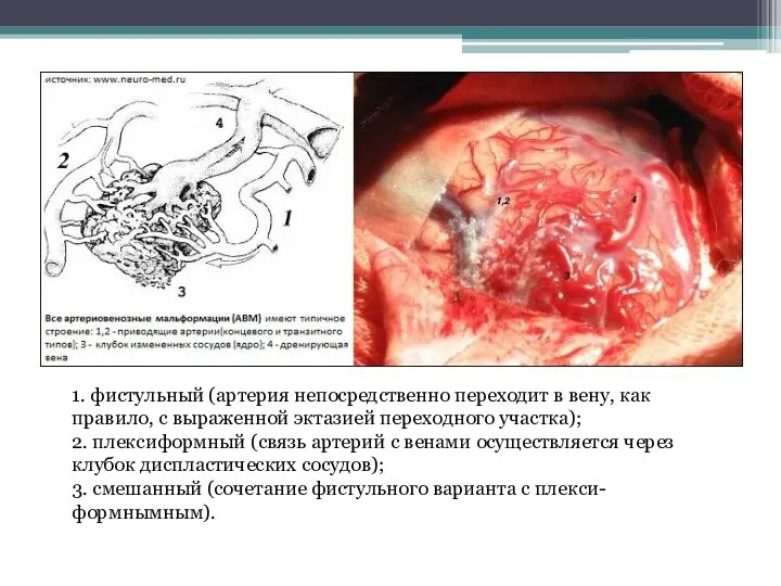 1. фистульный (артерия непосредственно переходит в вену, как правило, с выраженной эктазией переходного