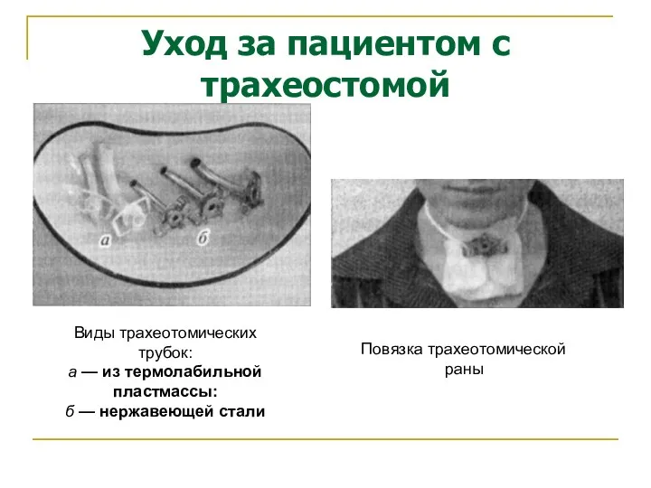 Уход за пациентом с трахеостомой Виды трахеотомических трубок: а —