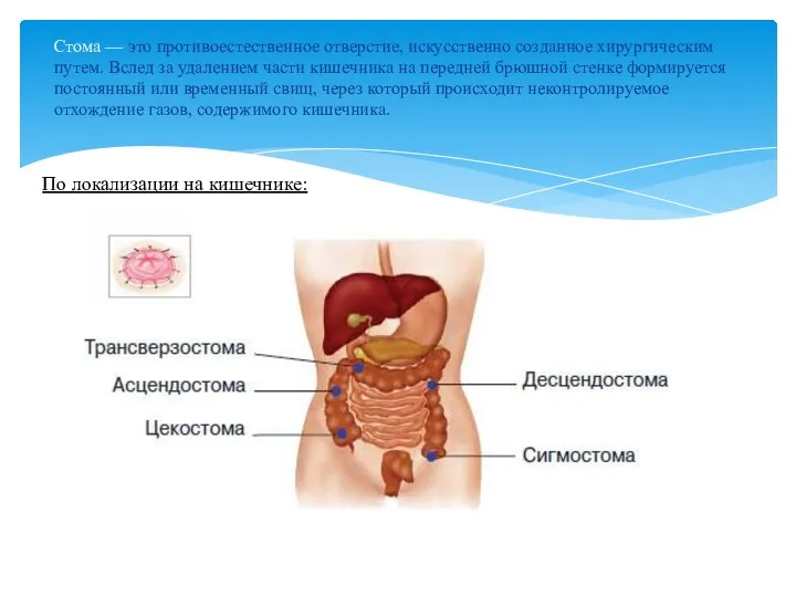 Стома — это противоестественное отверстие, искусственно созданное хирургическим путем. Вслед