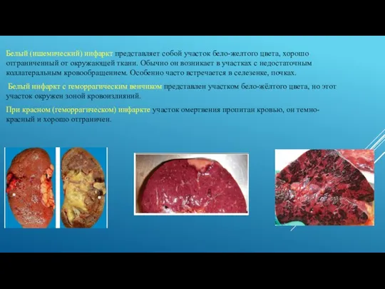 Белый (ишемический) инфаркт представляет собой участок бело-желтого цвета, хорошо отграниченный